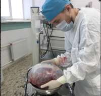 Красноярские врачи удалили женщине опухоль размером с арбуз