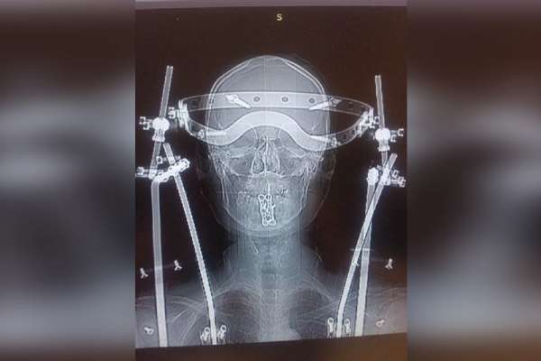 Красноярские врачи спасли двоих пациентов с тяжелейшими травмами шеи